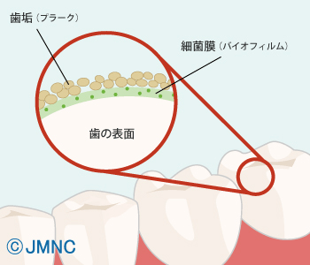 虫歯とは